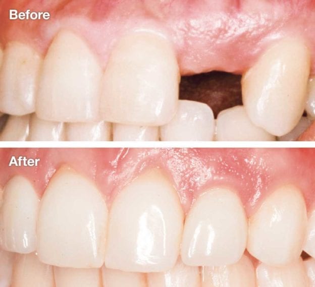 Tooth Extraction Before & After